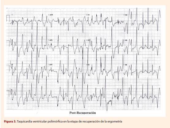 taquicardia ventricular polimórfica